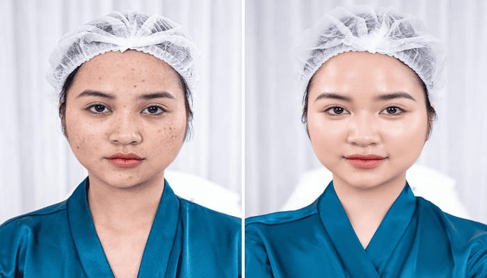 Hành trình xóa tan nám chân sâu của chị Tuệ Minh – Hà Nội