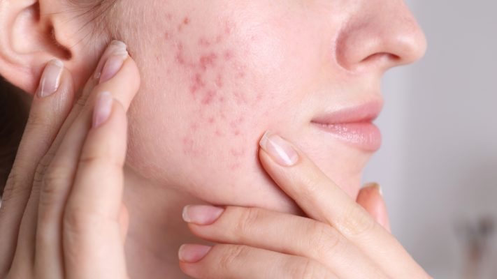Trị sẹo rỗ Gen 4.0: Giải pháp đột phá cho làn da mịn màng